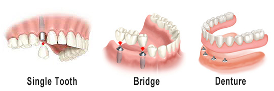 Dental Implant Bridges and Dentures Palo Alto