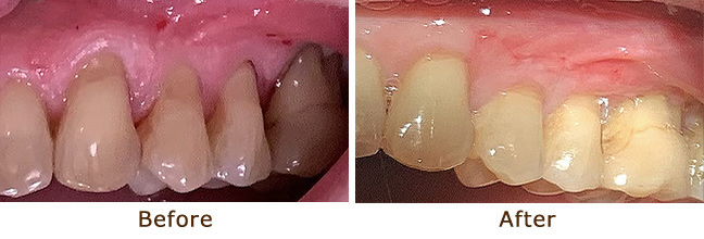 Gum Graft For Gingival Recession Before & After 1