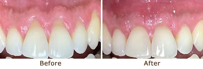 Gum Lifting & Gum Grafting Before and After