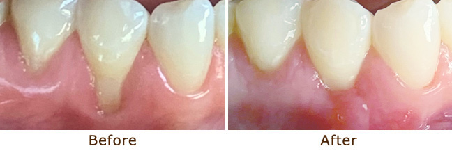 Gum Graft Palo Alto Before and After