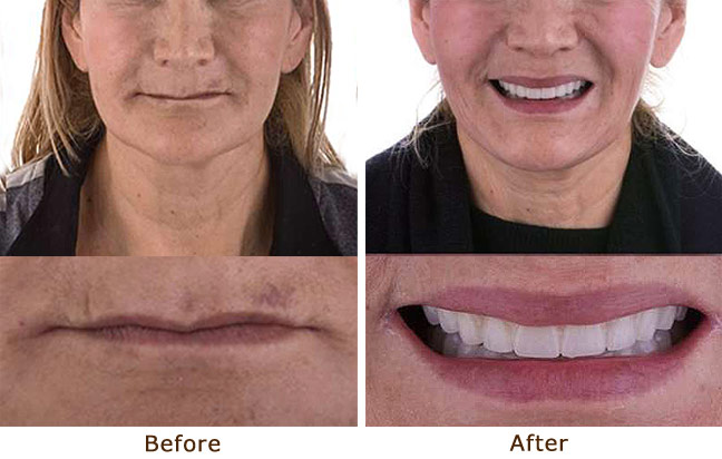 Periodontal Oral Surgery, 6 Upper & Lower Arches with Sinus Lift