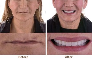 Periodontal Oral Surgery, 6 Upper & Lower Arches with Sinus Lift