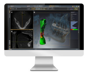 3D solution for OSA Therapy