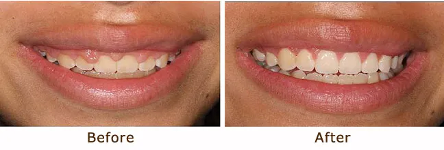 Aesthetic Crown Lifting