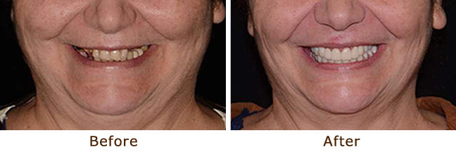Full Mouth Reconstruction with Implants, Veneers & Crowns