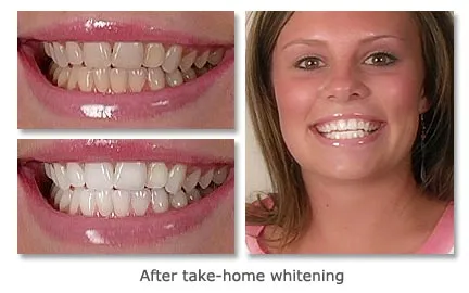 Before and after take-home whitening showing visibly brighter teeth