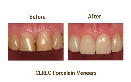 Before and after CEREC Porcelain Venners