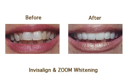 Before and after Invisalign & Zoom Whitening