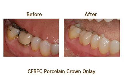 Before and after CEREC Porcelain Crown Onlay