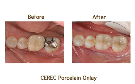 Smile improvement with CEREC porcelain onlay in a before and after view.