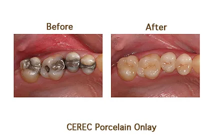 Teeth comparison before and after applying CEREC porcelain onlays for a natural look.
