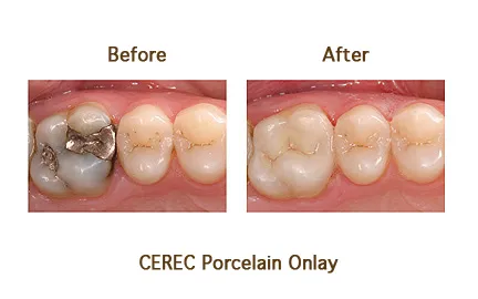 Before and after CEREC Porcelain Onlay