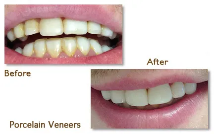 Comparison of teeth before and after applying porcelain veneers for a more even smile.