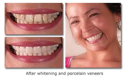 Before and after whitening and porcelain veneers showing a brighter, even smile.