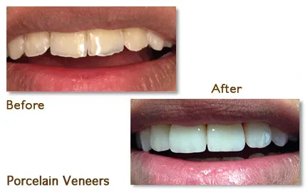 Before and after straight teeth with invisalign for improved alignment