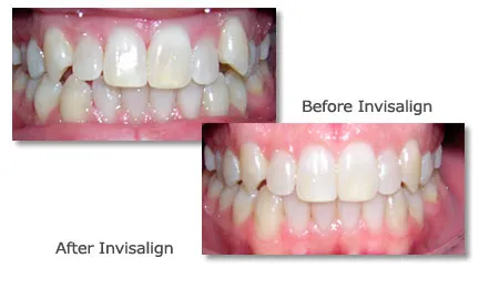 Before and after veneers showing improved tooth shape and color