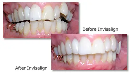 Before and after teeth straightened using Invisalign, showcasing improved alignment.