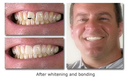 Teeth transformation with whitening and bonding in a before and after comparison.