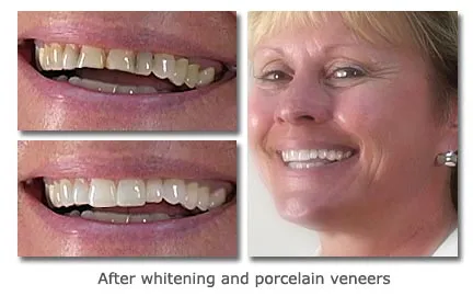 Teeth comparison before and after whitening and applying porcelain veneers.