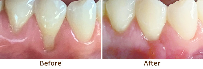 Healthy, restored gumline after a successful gum graft procedure.