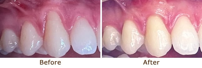 Showing uneven gums prior to gum grafting.