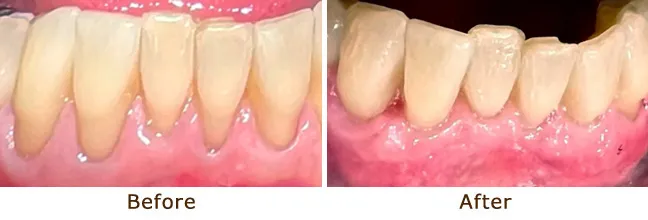 uniform appearance post-graft.