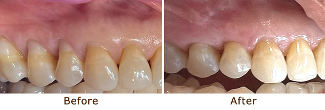 Natural gumline restored
