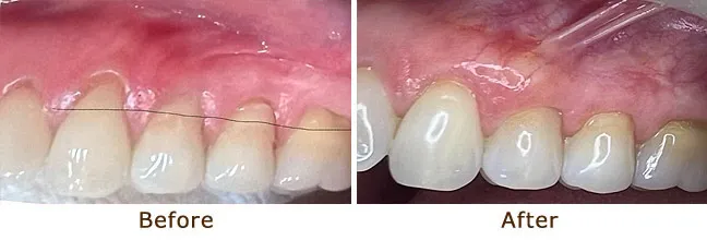 Improved gum symmetry and coverage following a gum graft.