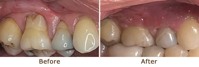 Fully covered tooth root with natural-looking gum tissue post-graft