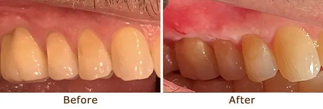 Gum Graft for Gingival Recession