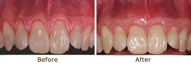 Gum Graft – Soft Tissue Augmentation