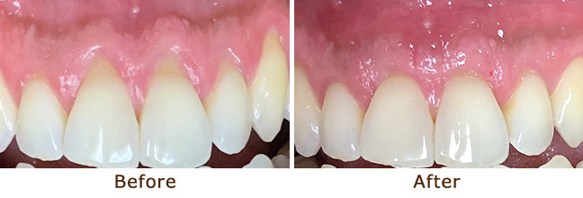 Gum Lifting and Gum Grafting