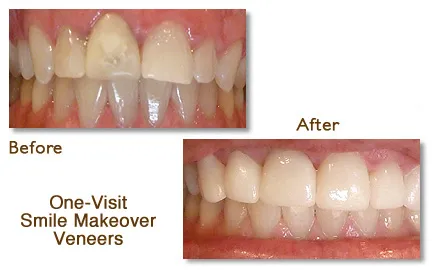 Before and after venners