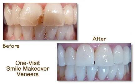 eeth after whitening and porcelain veneers, showing a bright, even smile.