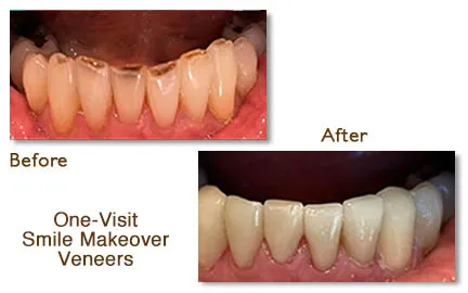Before and after comparison of teeth treated with one-visit smile makeover veneers.