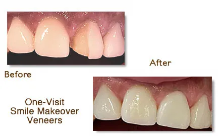 Close-up of teeth showing the transformation with one-visit smile makeover veneers.
