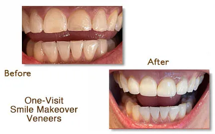Before and after smile make over veneers