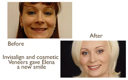 Invisalign before and after