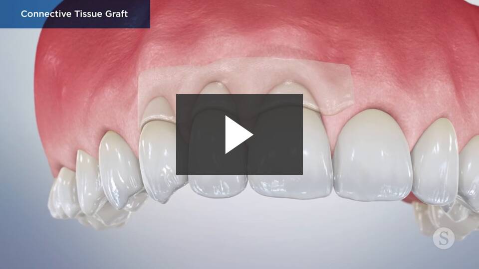 Gum Graft video thumbnail