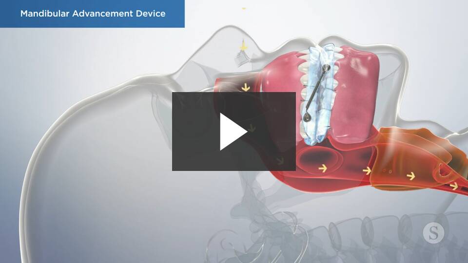 Sleep Apnea Appliance video thumbnail