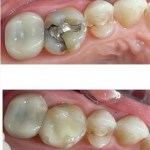 Before and Afters porcelain onlays