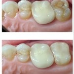 porcelain onlays before and after