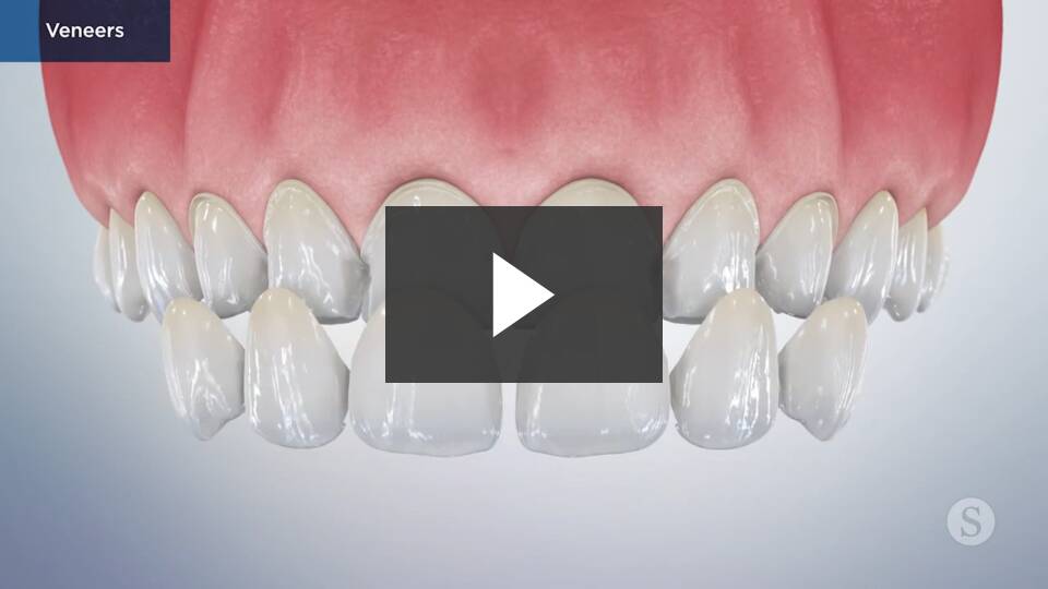 Cosmetic Veneers video thumbnail