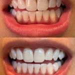 before and after zoom teeth whitening