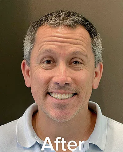 Our Patient Chris After Invisalign Treatment