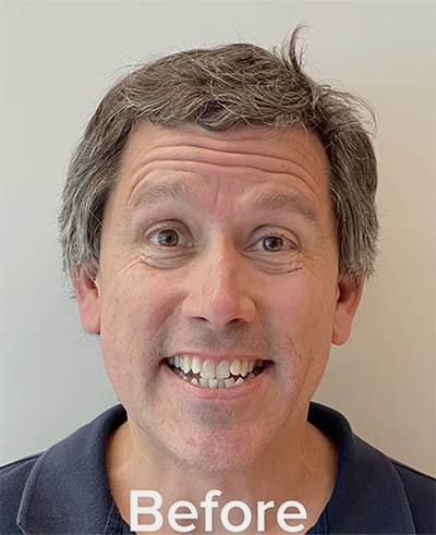 Our Patient Chris Before Invisalign Treatment