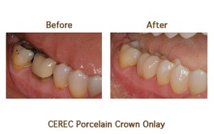 Before & After CEREC crowns